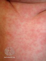 Roseola