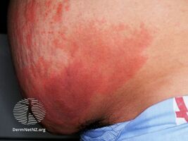 Heparin induced thrombocytopenia