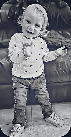 Kabuki syndrome 11.jpg