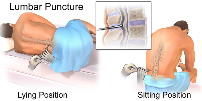 Lumbar puncture procedure for diagnosing aseptic meningitis