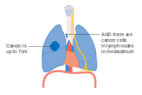 Stage IIIA lung cancer