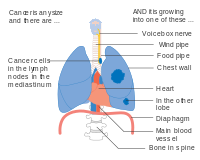 Stage IIIB lung cancer