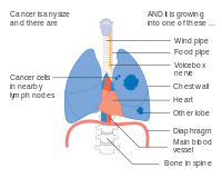Stage IIIA lung cancer