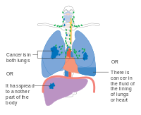 Stage IV lung cancer