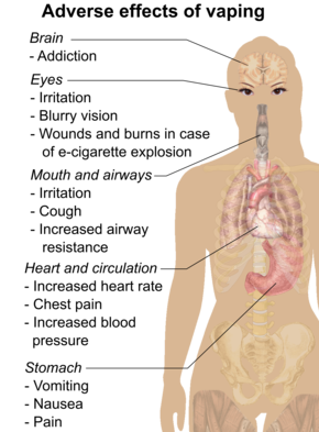 Serious adverse effects of vaping include corneoscleral lacerations or ocular burns or death after e-cigarette explosion. Less serious adverse effects of vaping include eye irritation, blurry vision, dizziness, headache, throat irritation, coughing, increased airway resistance, chest pain, increased blood pressure, increased heart rate, nausea, vomiting, and abdominal pain.
