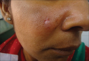 PMC3969703 IJD-59-210d-g001 (1).png