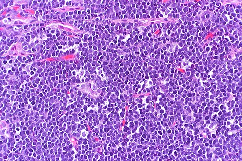 High-power view of Burkitt lymphoma with "starry sky" appearance. H&E stain.