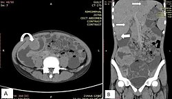 Lymphoma may appear as peritoneal lymphomatosis, as can be seen on CT scan. Image depicts non-Hodgkin lymphoma in a 17 year old who is HIV positive. A. Irregular homogenously enhancing wall thickening involving the ileocaecal region with aneurysmal dilatation of involved segments (curved arrow). B. Hepatosplenomegaly with liver metastasis (white arrows).[23]