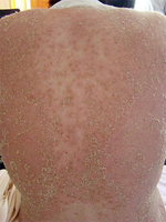 Impetigo herpetiformis2.png