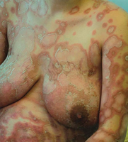 Pustular psoriasis of pregnancy.png