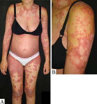 Impetigo herpetiformis3.png