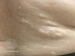 Tuberous sclerosis shagreen patch