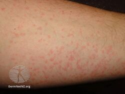 Cold urticaria