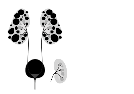 Autosomal dominant polycystic kidney disease