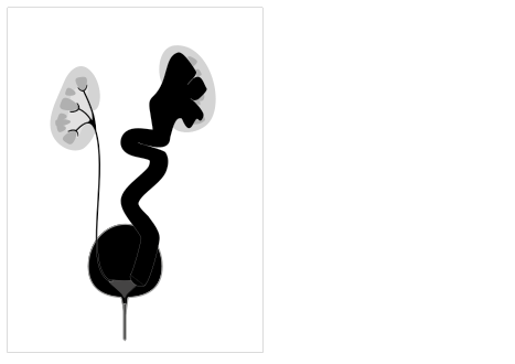 High grade vesico-ureteric reflux - easily mistaken for cystic renal disease on early scans
