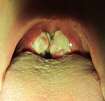 Sore throat due to glandular fever