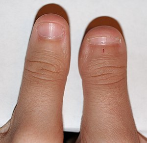 Clubbed thumb.jpg