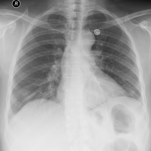 Radiology 2706 1407 empyema progression nevit.gif