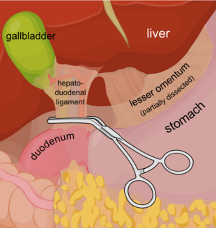 Pringle manoeuvre EN.svg