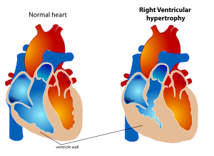 Right Ventricular hypertrophy.svg