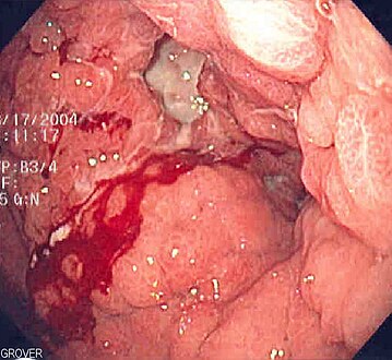 Endoscopic image of linitis plastica, a diffuse type of stomach cancer characterized by a thickening and rigidity of the lining of the stomach, leading to a leather bottle-like appearance with blood coming out of it