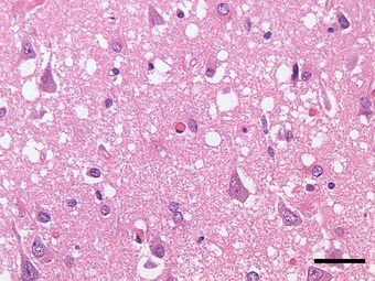 Spongiform degeneration in Creutzfeldt-Jakob disease.jpg