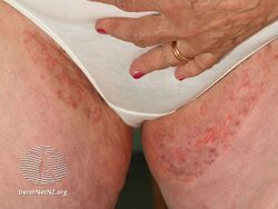 Tinea cruris (groin)