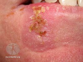 The following side effects can occur in the treated areas