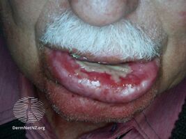 The following side effects can occur in the treated areas