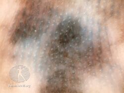 Parallel ridge pattern with diffuse pigmentation