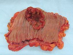 An invasive colorectal carcinoma (top center) in a colectomy specimen