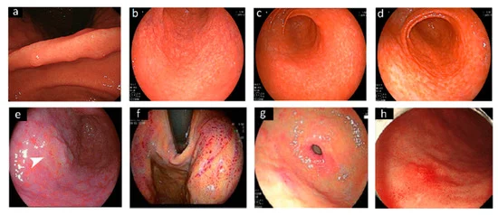 Different endoscopic patterns related to H. pylori infection.[105]