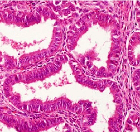 Histopathology of well-differentiated endometrioid adenocarcinoma.png