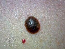 Seborrhoeic keratosis