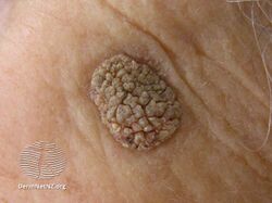 Seborrhoeic keratosis
