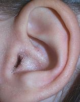 Auricular eczema