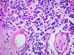 IgG4-related skin disease pathology