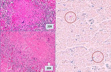Histopathology, showing epithelioid granulomas with multinucleated giant cells and acid-fast bacilli