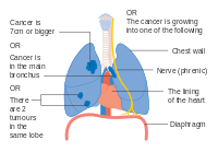 One option for stage IIB lung cancer, with T2b; but if tumor is within 2 cm of the carina, this is stage 3