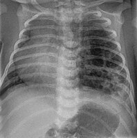 CPAM on chest radiograph in a newborn. Large cystic changes in the left lung, leading to a mediastinal shift to the right due to their mass effect.