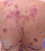 Pemphigus vulgaris (DermNet NZ pemphigus-vulgaris-18).jpg