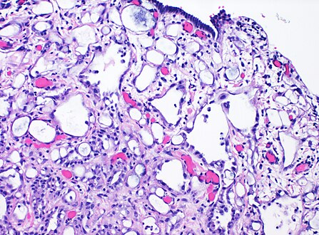 High magnification of the same case, showing the typical[10] features of tubular spaces of varying size composed of flattened cells resembling endothelium.