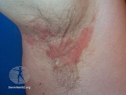 Seborrhoeic dermatitis underarms