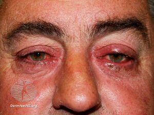 Ocular rosacea