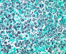 Photomicrograph (stained) of Prototheca wickerhamii infection in a human