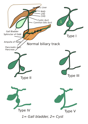 Choledochal cysts.svg