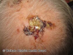 Erosive pustular dermatosis