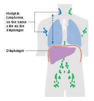 Stage 2 Hodgkin lymphoma