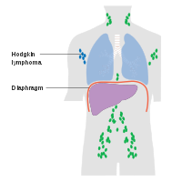 Stage 1 Hodgkin lymphoma