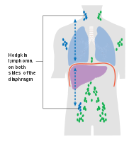 Stage 3 Hodgkin lymphoma
